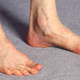 Image for article titled Anti-Vaxxers Are Harassing This Poor Woman Who Just Wants Treatment for Her Fucked Up Foot